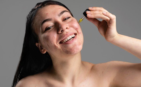 Акне не проходит — вам нужны витамины от прыщей: дерматологи объясняют, как работает каждый