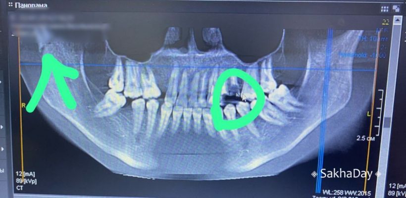 Росздравнадзор выявил нарушение у Республиканской больницы №2: не диагностировали перелом челюсти у жертвы домашнего насилия