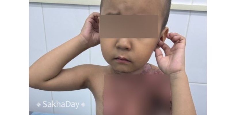 В Якутске мальчик, которого подожгли на детской площадке, не может ходить по неизвестной причине