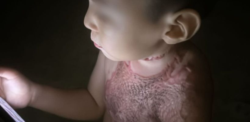 «Родители должны отвечать за пиромана»: В Намцах мальчик, поджегший другого ребенка, не подлежит к уголовной ответственности по возрасту