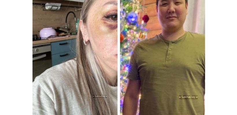 Он сказал: «Ты сейчас умрешь» и ударил кулаком в лицо. В Якутии очередной агрессор, избивший женщину, может избежать наказания