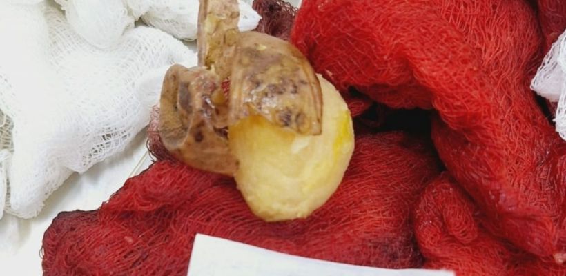 Жительница Якутии проглотила картофель целиком. Ей сделали операцию