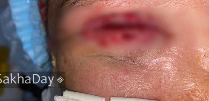 Житель Якутии лишил своего друга зрения, выплеснув марганцовку в глаз