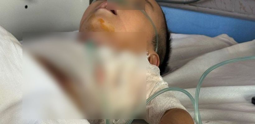 В Якутске оперировали Марка Охлопкова, которого подожгли на детской площадке