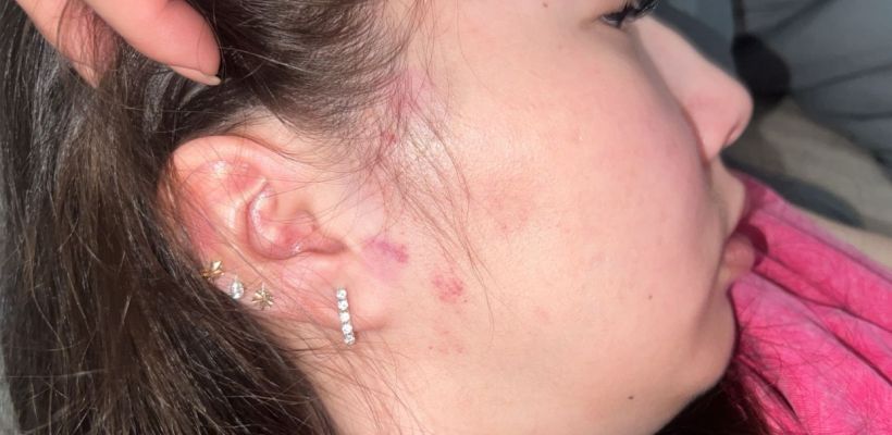 «Нет живого места на теле»: Жительница Якутска обвинила полицейского в побоях