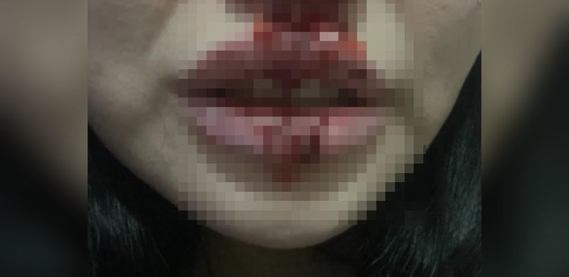 Жительница Якутска разыскивает таксиста, сломавшего ей нос