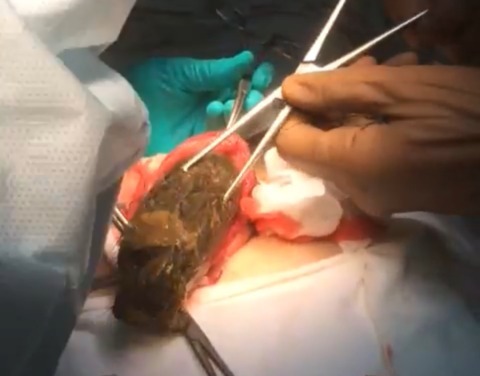 О видеосъемке операции по извлечению трихобезоара