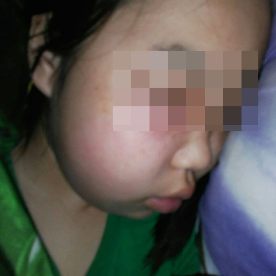 Для помощи девочке из Якутии, мучающейся от зубной боли, понадобилась огласка в соцсетях
