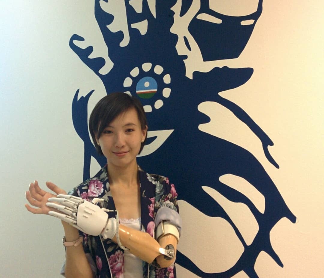 Якутяне сделали бионический протез руки, распечатанный на 3D-принтере