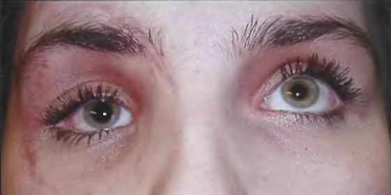 ОПУЩЕНИЕ ГЛАЗА