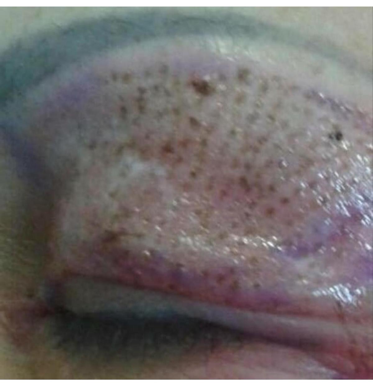 Страшные последствия ожога