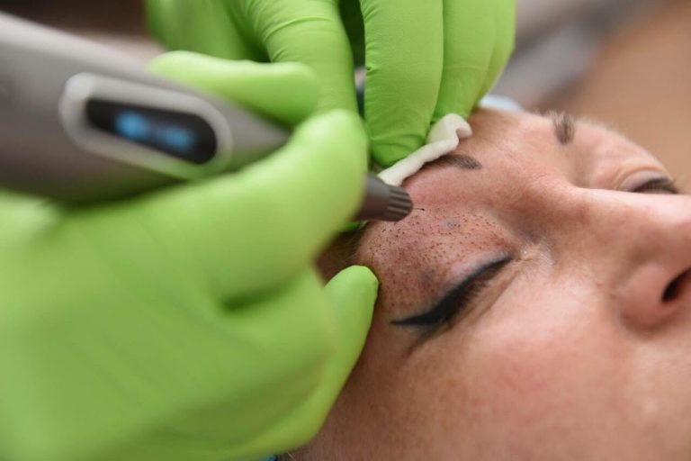 plazmennoe-omolozhenie-litsa-otzyvy-s-foto-do-i-posle-02-768x512