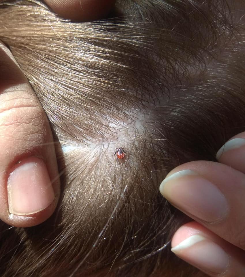 В Якутии четверо пострадали от укусов клещей