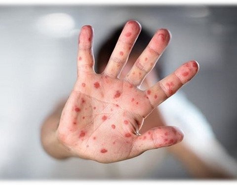 В  Якутске  зарегистрировано  68 случаев  кори