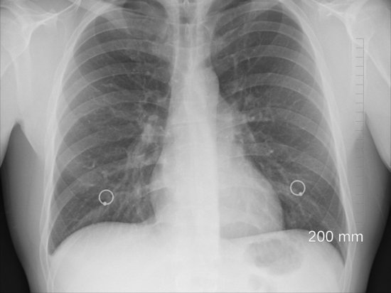 У выжившего после коронавируса жителя Севастополя осталось 30% легких