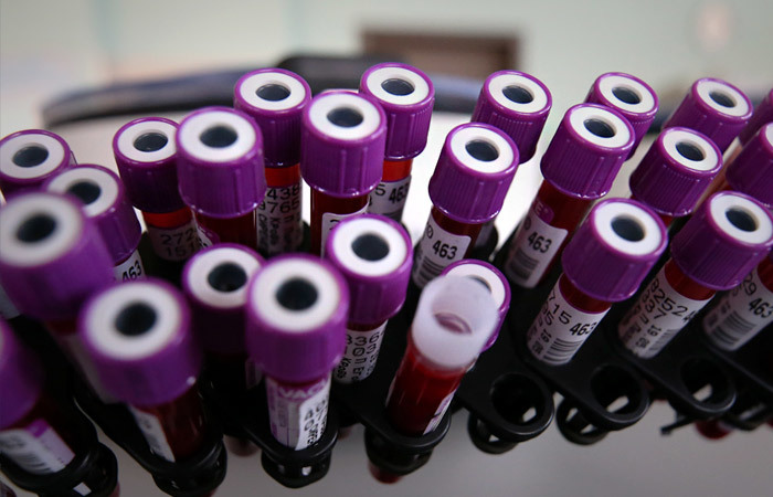 Минздрав рекомендовал не учитывать в статистике больных COVID-19 в легкой форме