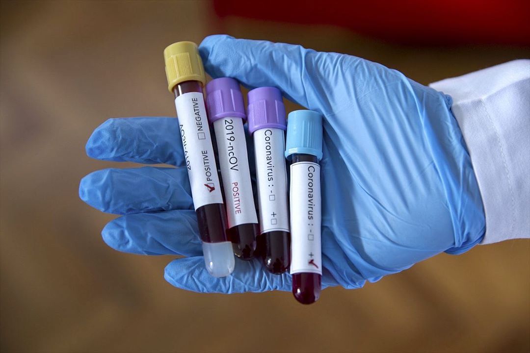 В Якутии за последние сутки выявлено 156 новых случаев заражения коронавирусом