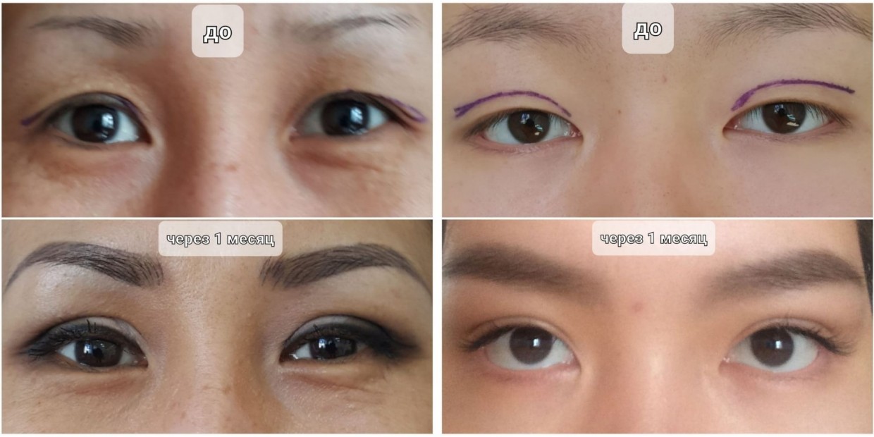 Якутская офтальмологическая больница приглашает на блефаропластику!