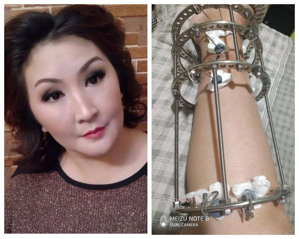 Горожанка, пострадавшая от укуса собаки, обратилась к мэру Якутска и депутату с просьбой о помощи