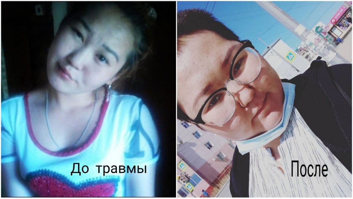 Якутянка стала инвалидом после жестокого избиения своим бывшим. Ей нужна помощь