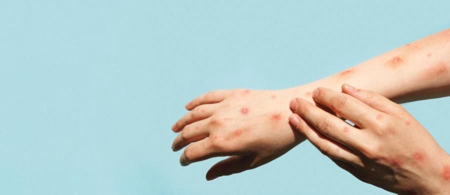 Якутия готова к угрозе оспы обезьян