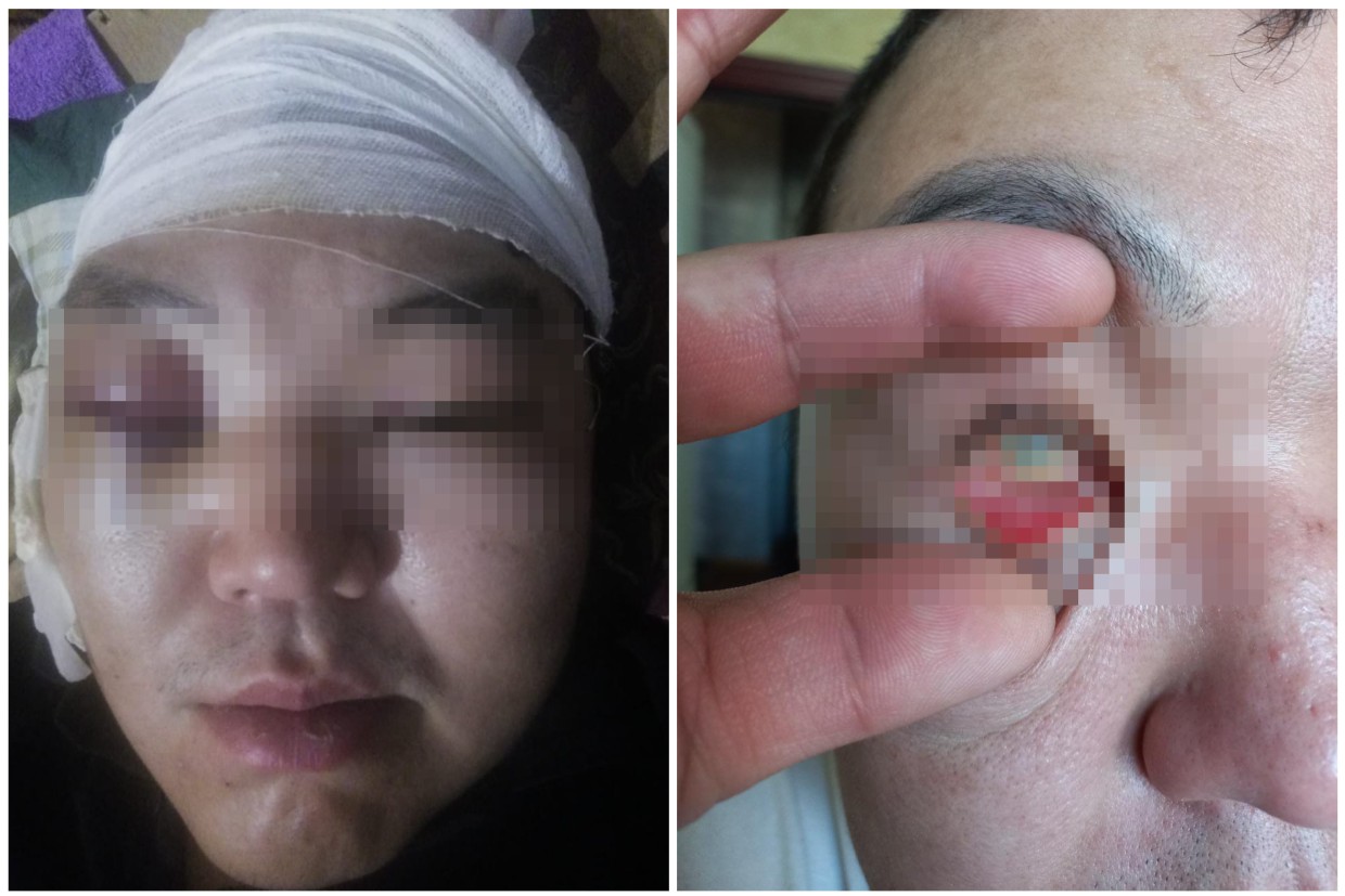 В Усть-Янском районе мужчину избили, лишили глаза и оставили умирать