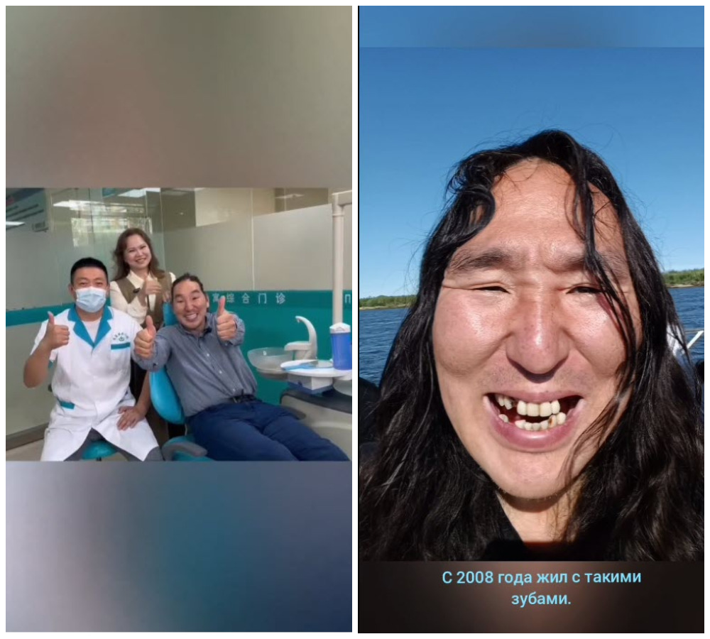 Волонтеру Антону Васильеву бесплатно восстановили зубы в Китае