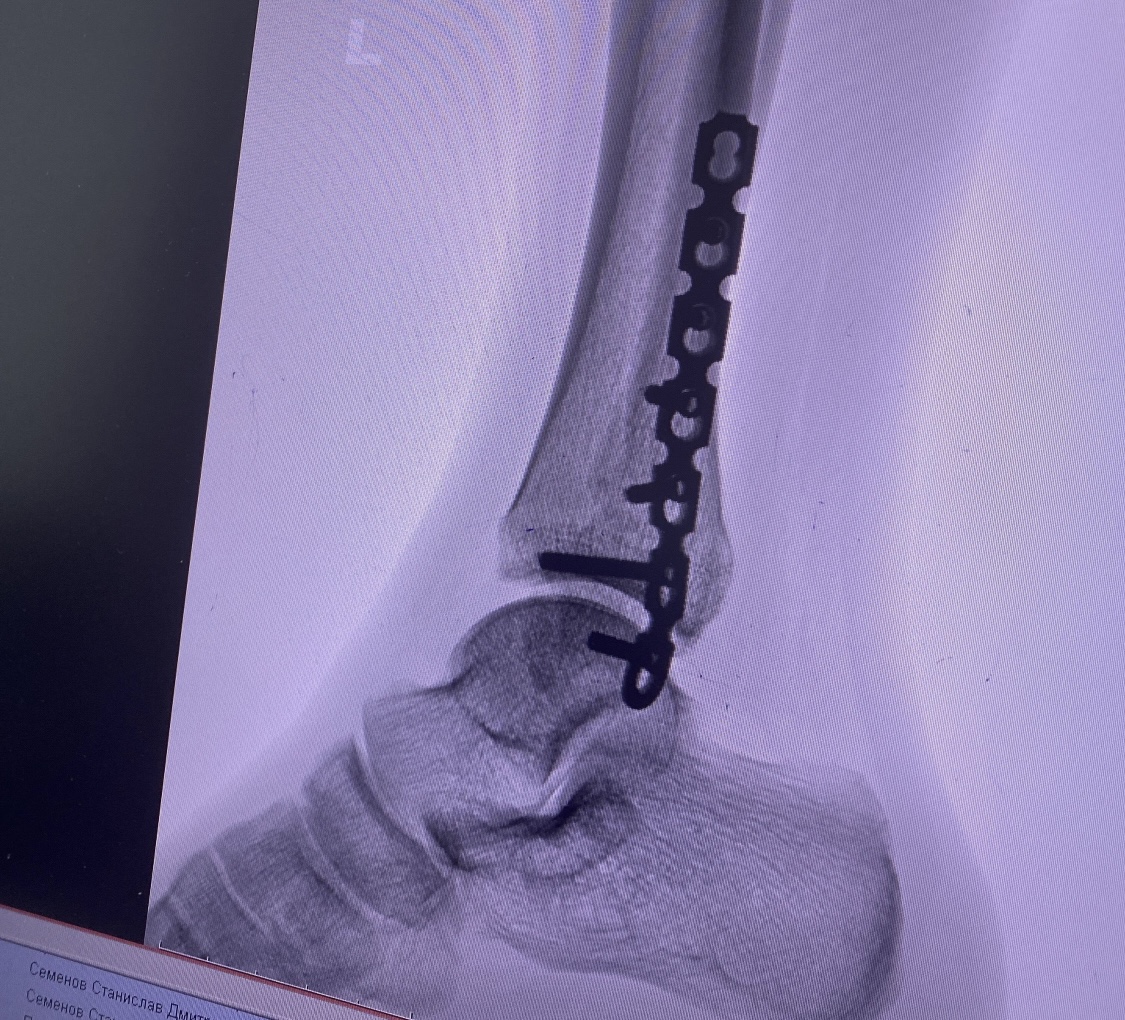 В травмпункте Якутска повторно сломался рентген-аппарат. Сроки ремонта неизвестны