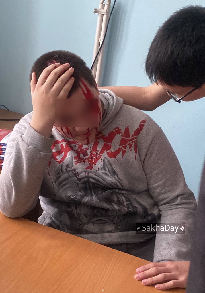 Школьнику, на которого упала плита в школе №3 в Якутске, наложили 7 швов. Родители пострадавших детей обратились в Следком