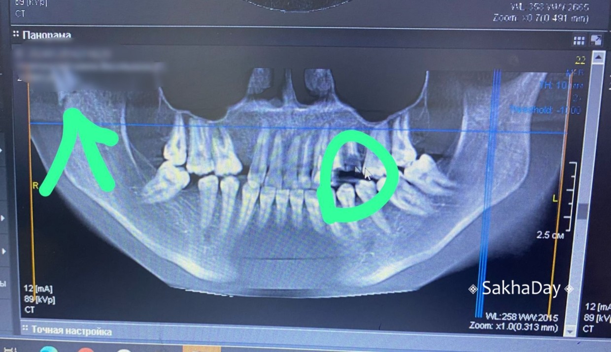 Росздравнадзор выявил нарушение у Республиканской больницы №2: не диагностировали перелом челюсти у жертвы домашнего насилия