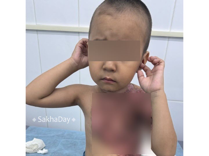 В Якутске мальчик, которого подожгли на детской площадке, не может ходить по неизвестной причине