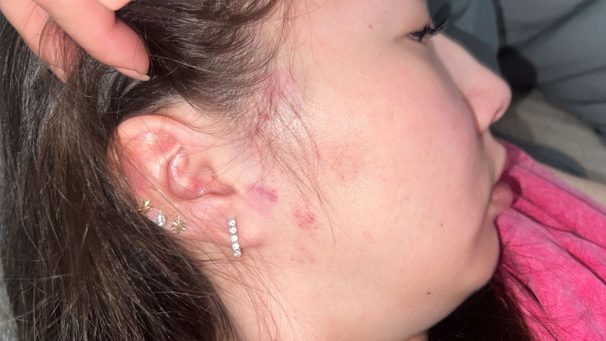 «Нет живого места на теле»: Жительница Якутска обвинила полицейского в побоях