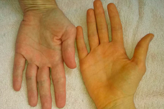 В ногах вся правда: рассказали о 3 неочевидных сигналах больной печени — все они заметны по состоянию ваших ног