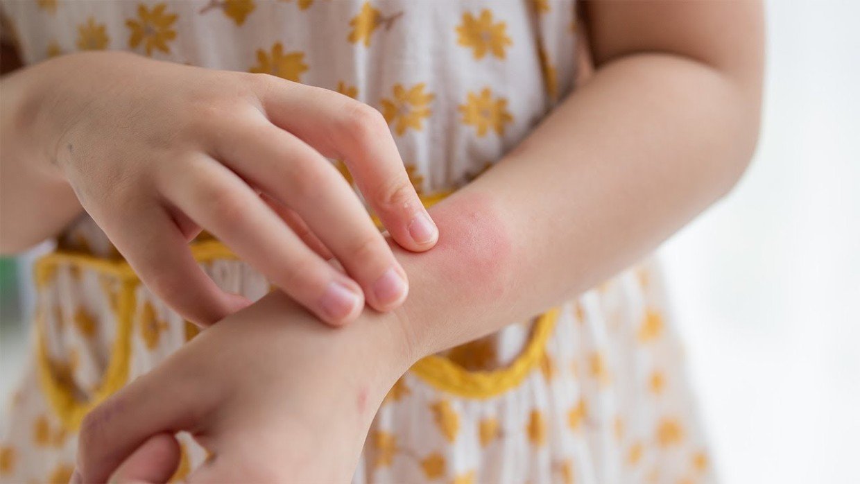 Не только аллергия: 3 неочевидные причины появления красных точек на теле