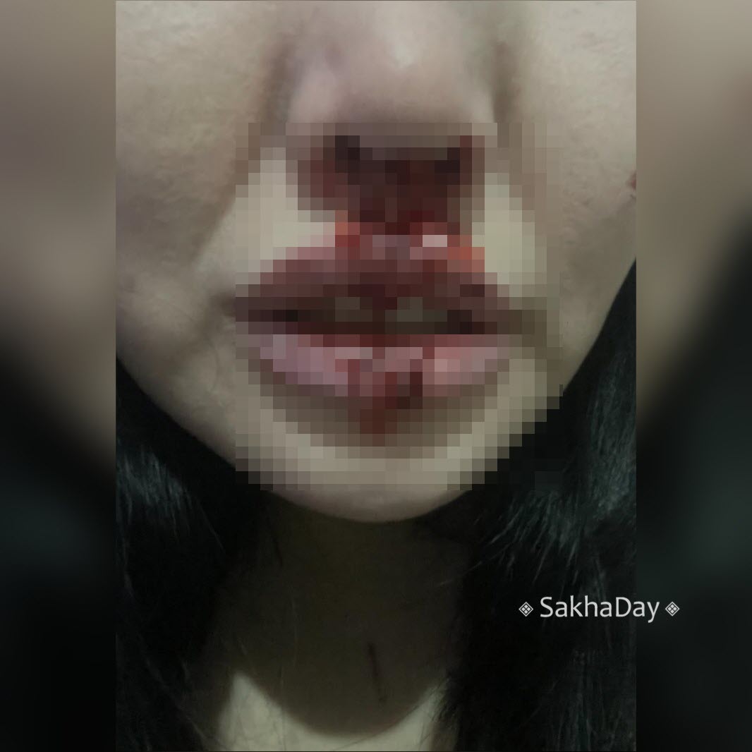 Жительница Якутска разыскивает таксиста, сломавшего ей нос