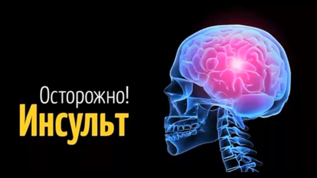 Как избежать катастрофы: 4 признака инсульта — важно вовремя их заметить
